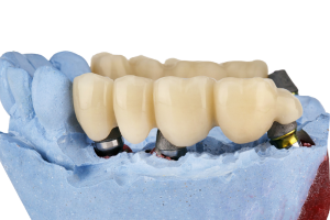 Implant bridges