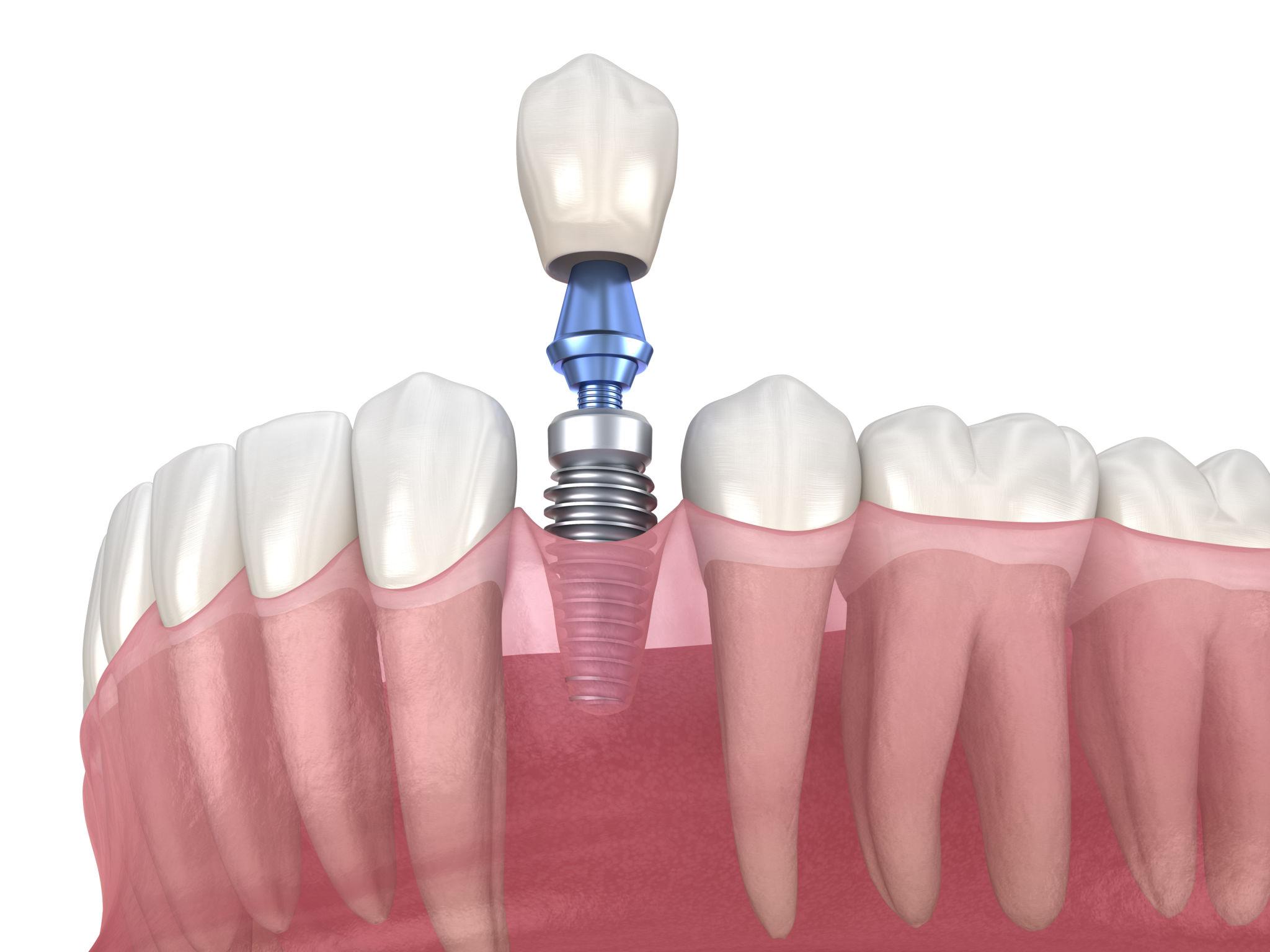 Full arch dental implants before and after at Jabade Dental Clinic Pune